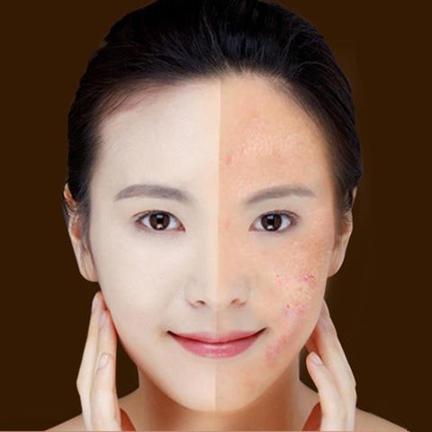 Blue Light Therapy Acne Laser Pen Soft Scar Wrinkle Removal Treatment Device Skin Care Beauty Equipment CJdropshipping